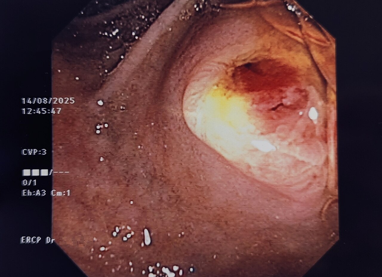 Endoscopic view of the papilla of Vater after sphincterotomy, with bile draining from the opening